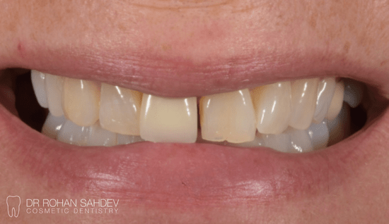 Before - Rohan Sahdev