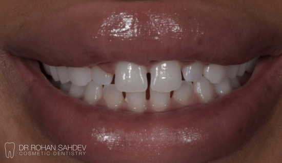 Before - Rohan Sahdev