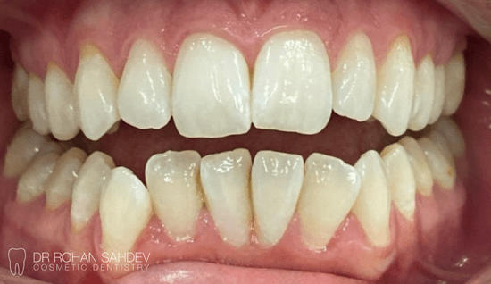 Before - Rohan Sahdev