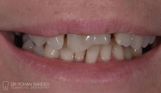 Before - Rohan Sahdev