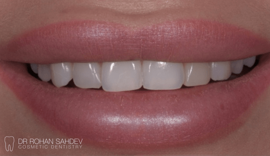 Before - Rohan Sahdev