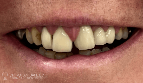 Before - Rohan Sahdev