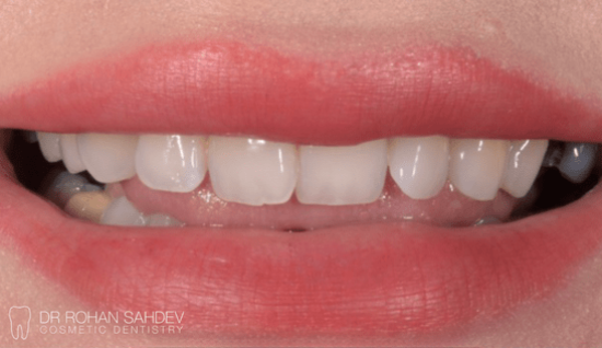 Before - Rohan Sahdev