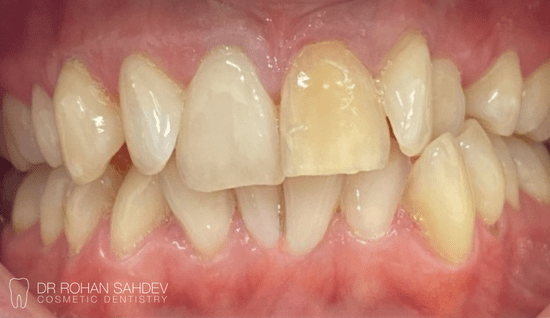 Before - Rohan Sahdev