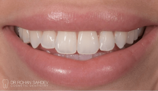 Before - Rohan Sahdev