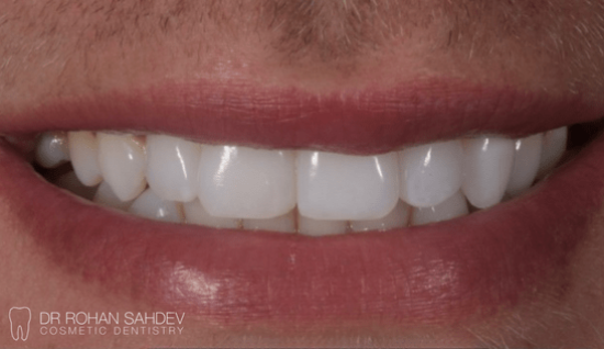 Before - Rohan Sahdev