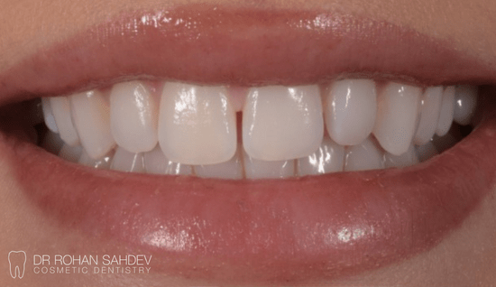 Before - Rohan Sahdev