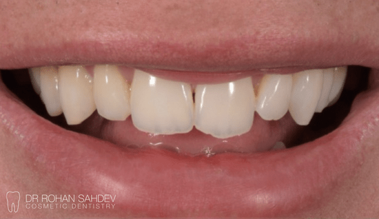 Before - Rohan Sahdev