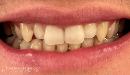 Before - Rohan Sahdev