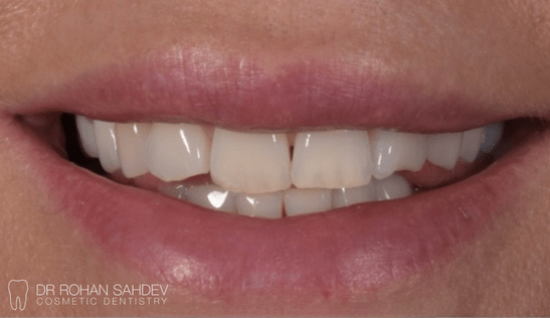 Before - Rohan Sahdev