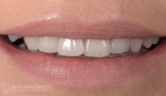 Before - Rohan Sahdev