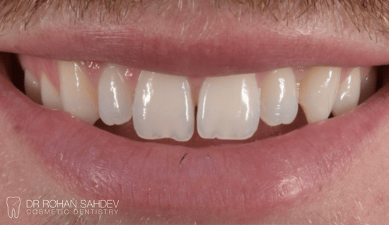 Before - Rohan Sahdev