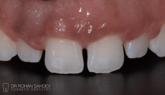 Before - Rohan Sahdev